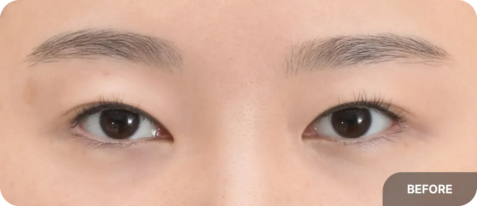 canthoplasty before