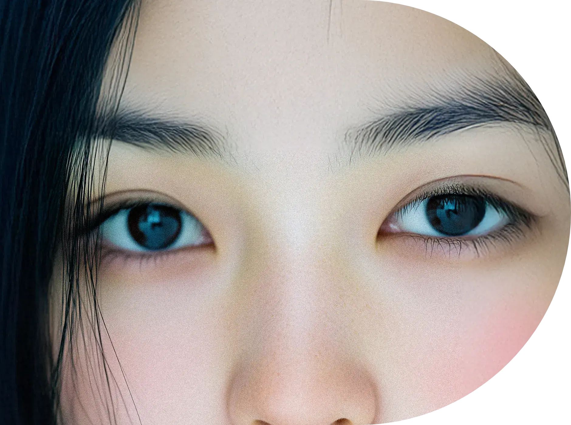 눈매교정 수술로 더 커진 눈 - 매력적인 눈매 변화