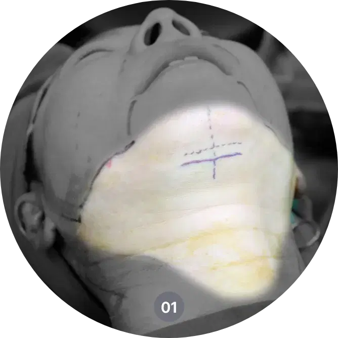neck lift procedure in Korea