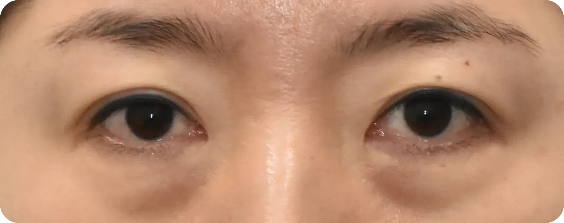 visible lower lid depression before eyelid fat graft