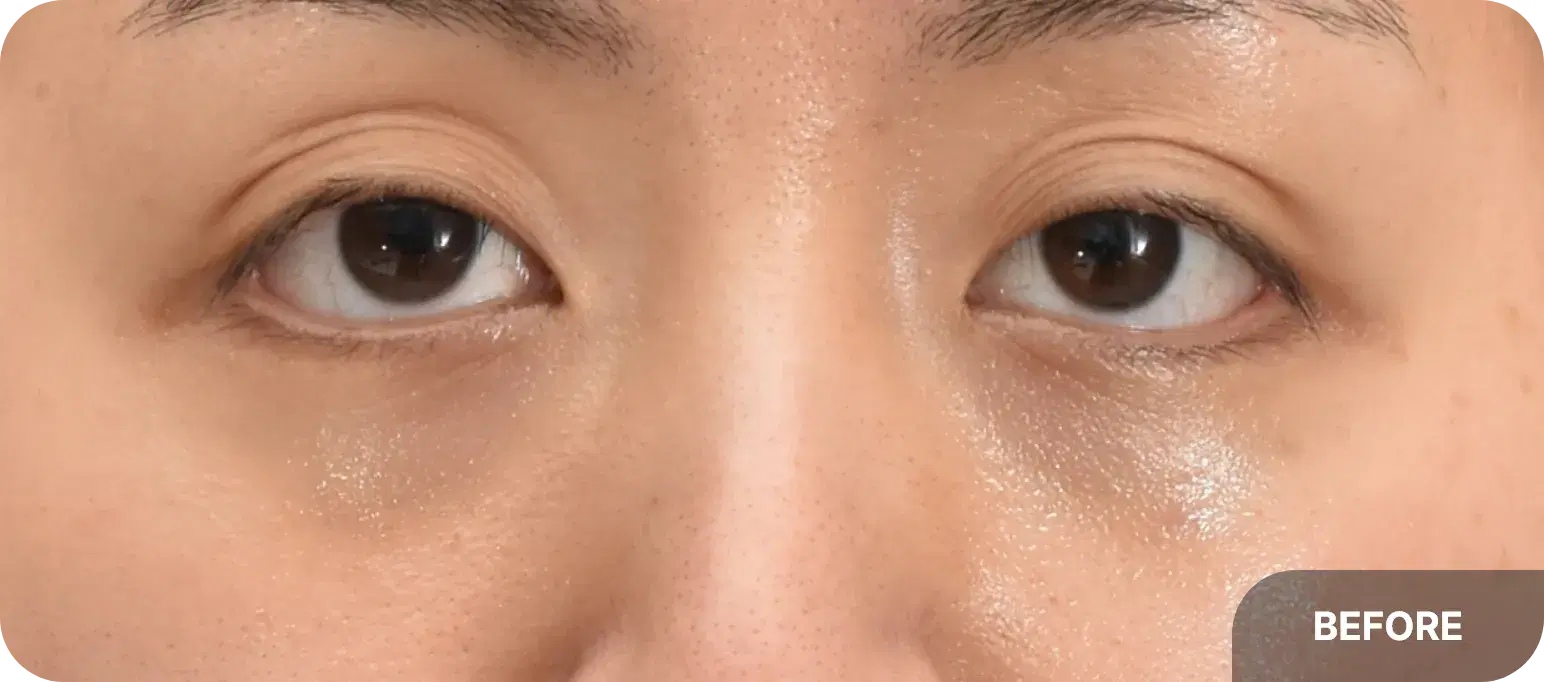 Before fat injection - noticeable upper lid hollowness and volume loss