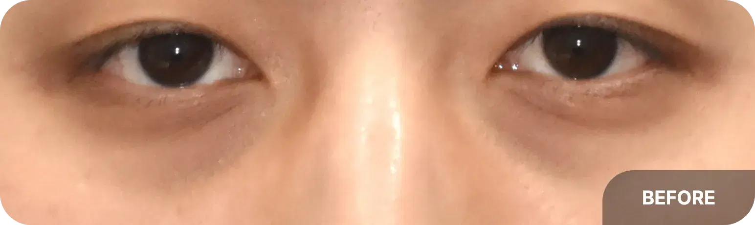 눈밑 다크서클을 눈밑지와 나노지방이식으로 치료한 눈높이성형외과의 사례