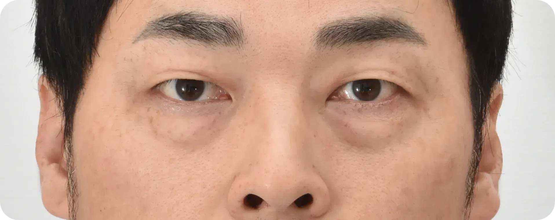 눈밑지방재배치 수술 전 40대 남성
