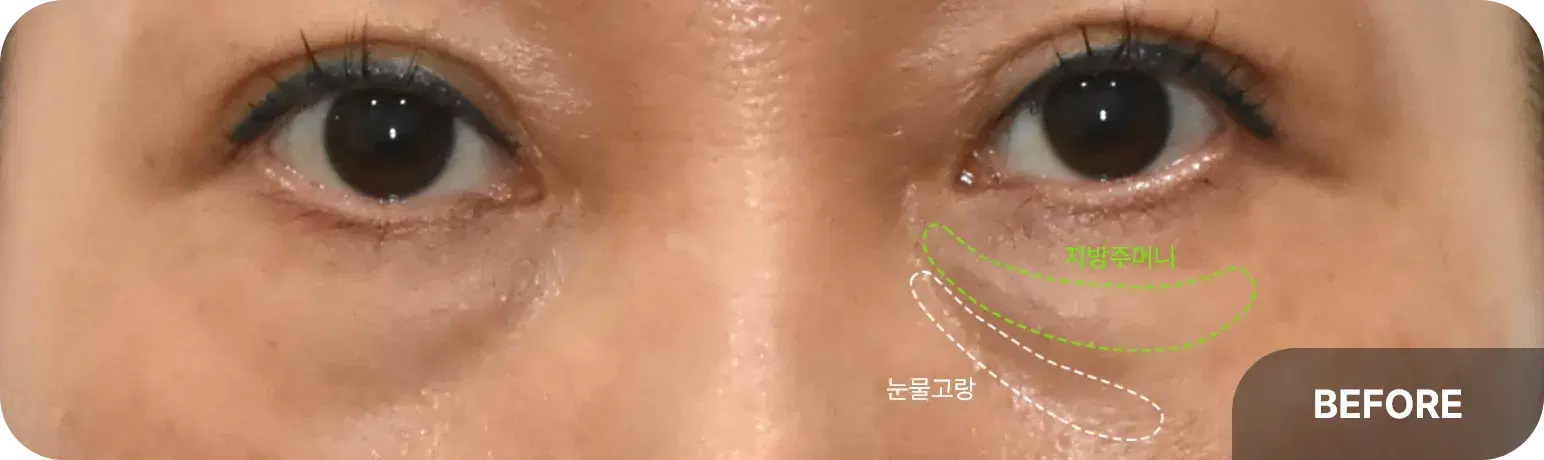눈밑 지방 재배치로 매끄럽고 생기 있는 눈가로 변화된 사례