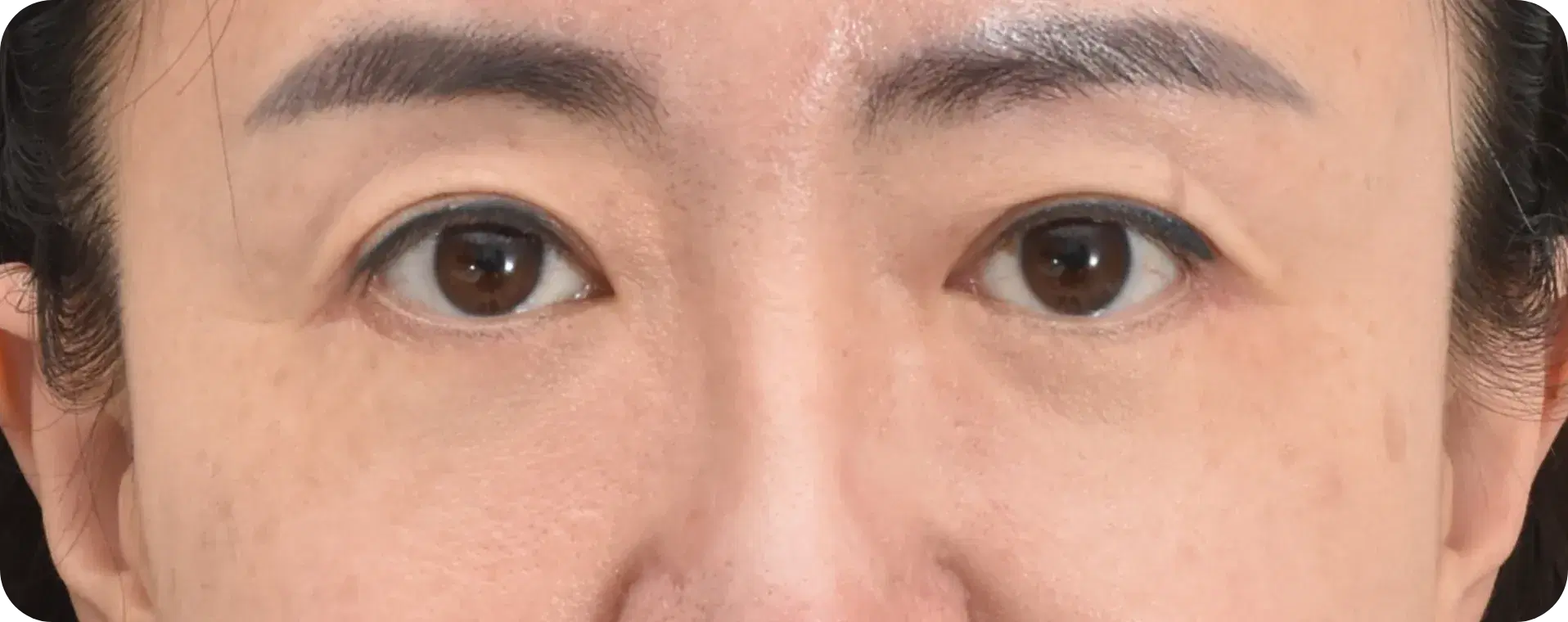 Korean upper blepharoplasty 3 month after - Eyelid rejuvenation and improved eye appearance
