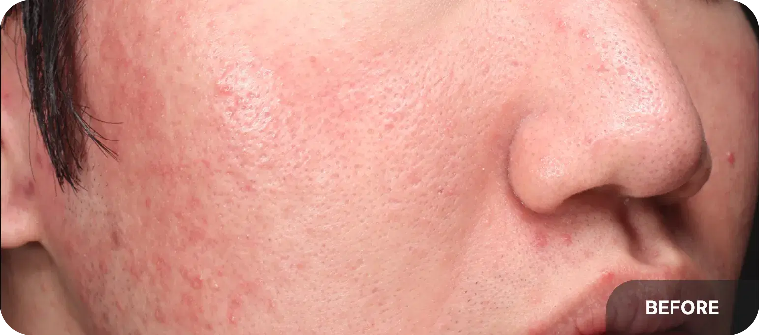 Before and after acne laser treatment