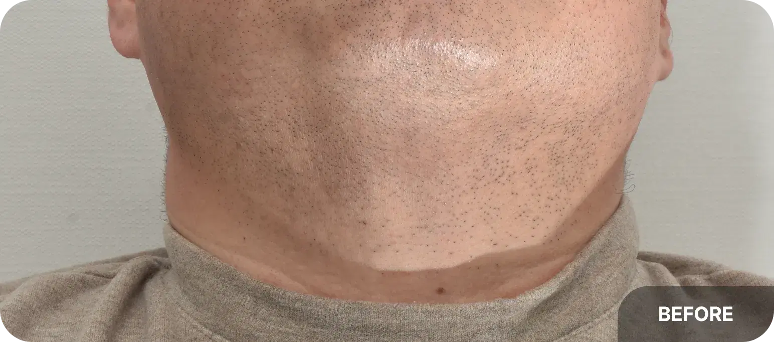 Before and after acne laser treatment