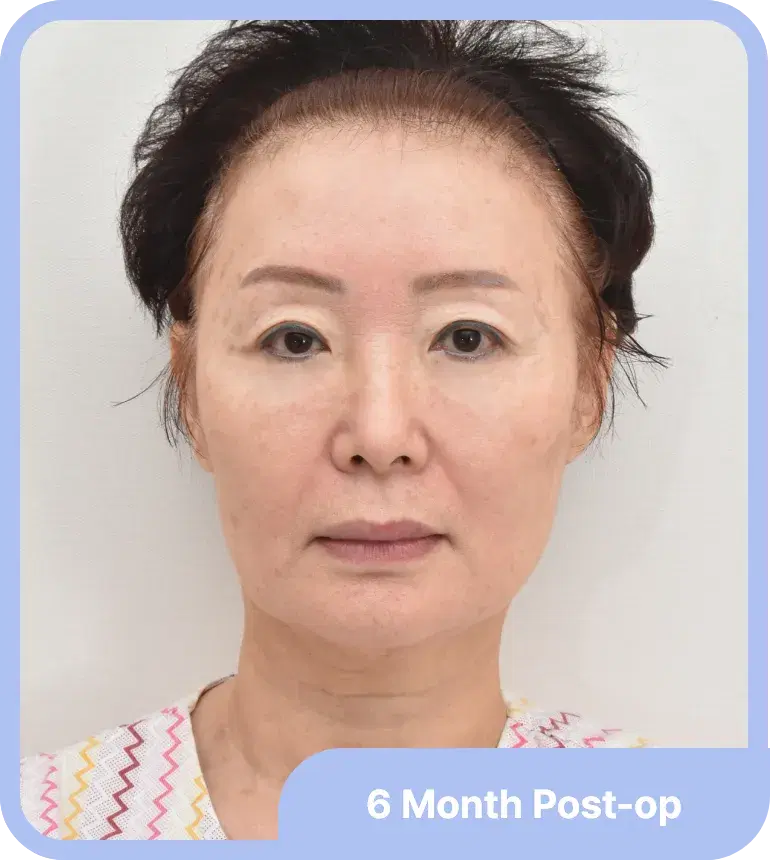 얼굴지방이식 후 자연스럽게 개선된 얼굴 윤곽과 피부 탄력