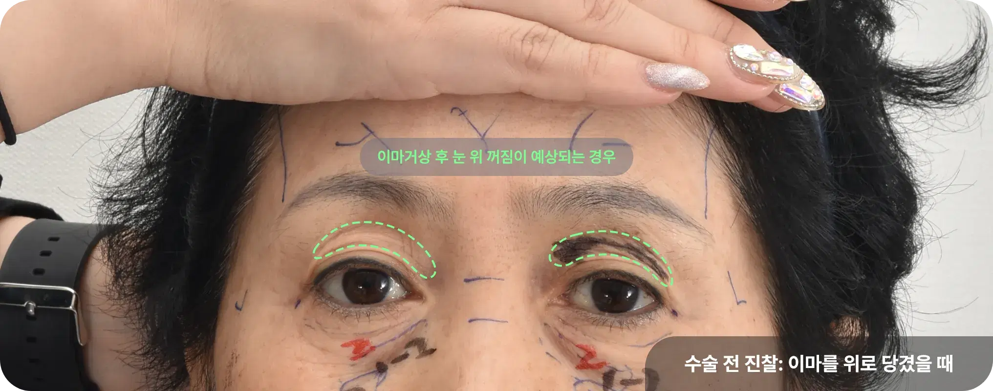이마거상과 눈 위 아이홀 지방이식이 필요한 경우 - 처진 눈썹과 꺼진 눈 위 개선