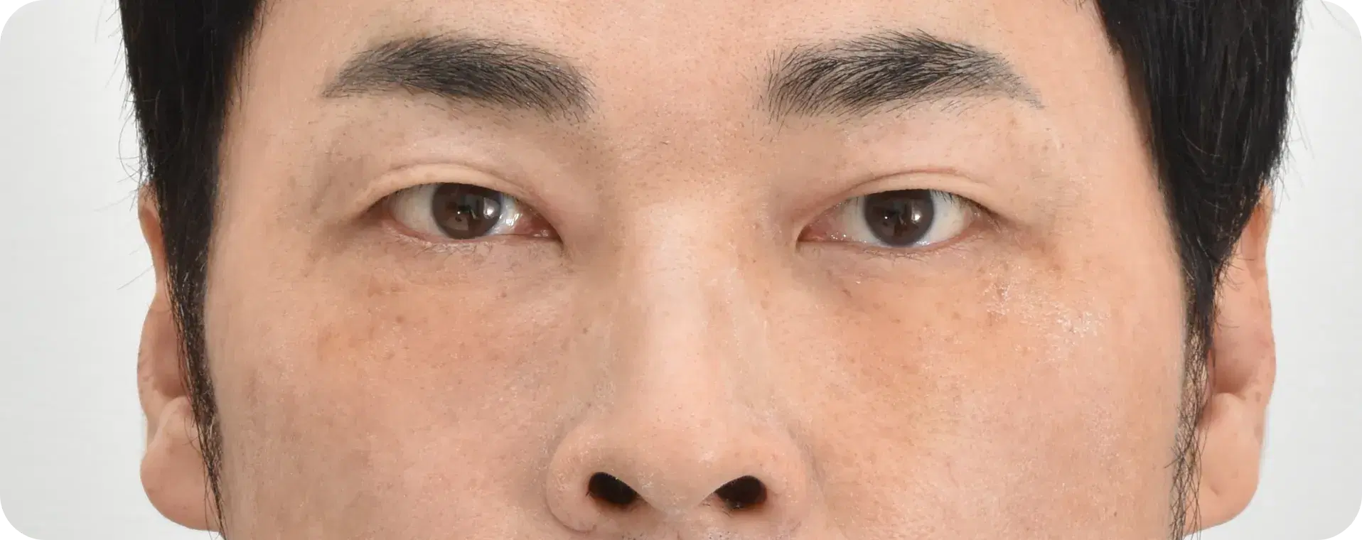 눈밑지방재배치 수술 후 - 돌출된 지방과 꺼진 눈물고랑이 개선된 모습