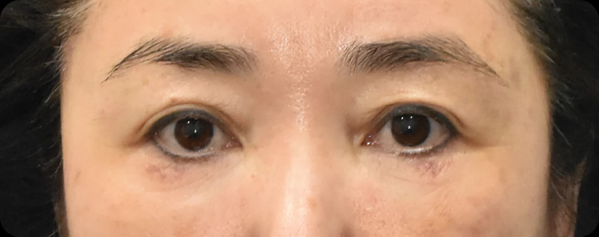 After endoscopic brow lift - lifting sagging brows and smoothening glabellar lines