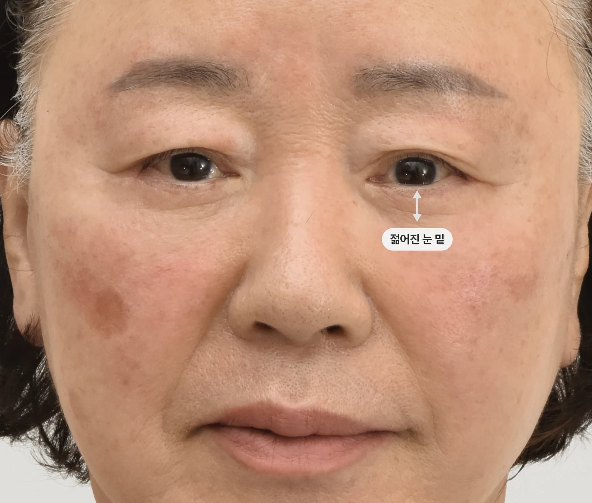 Post-facelift surgery - rejuvenated, youthful face with smooth jowls contours