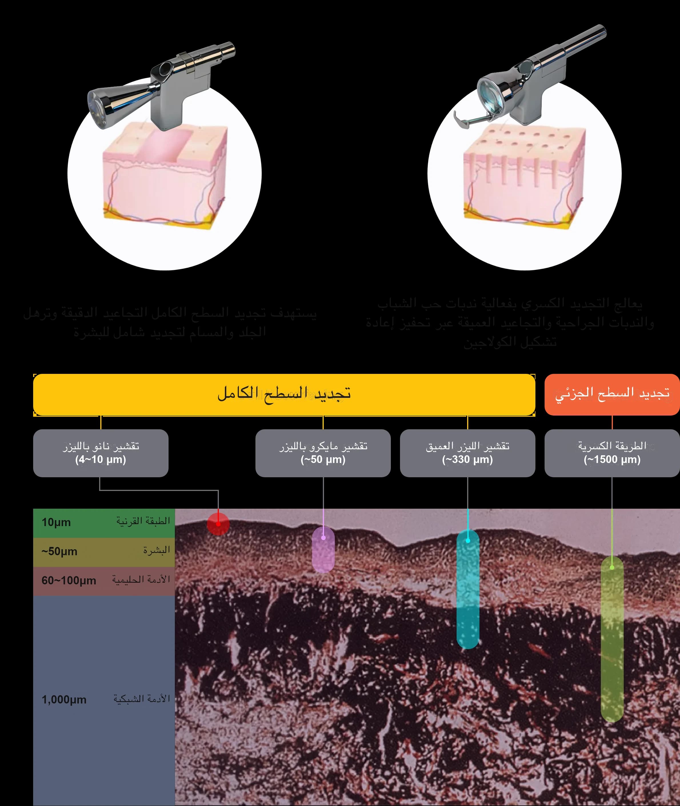 Sciton ZoomScan - full face facial resurfacing treatment/Sciton Profractional - fractional resurfacing laser/laser peeling with Sciton