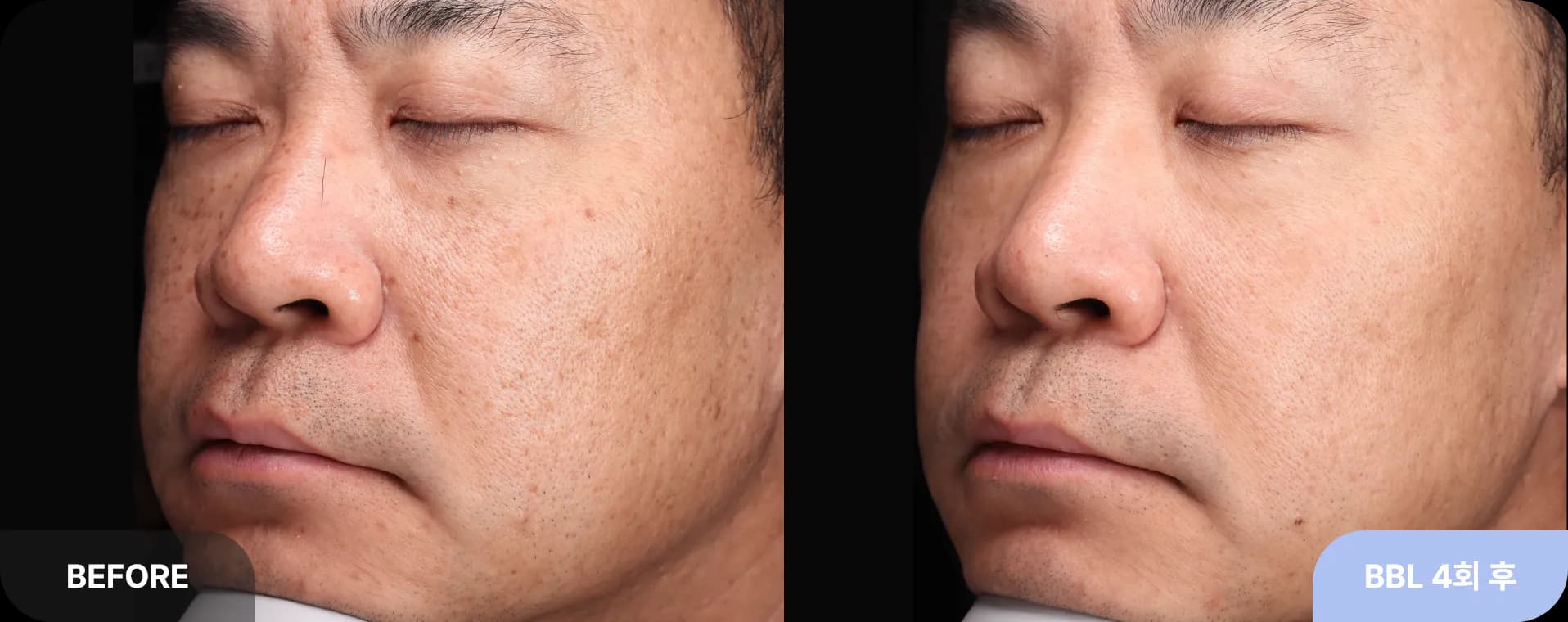 기미잡티레이저