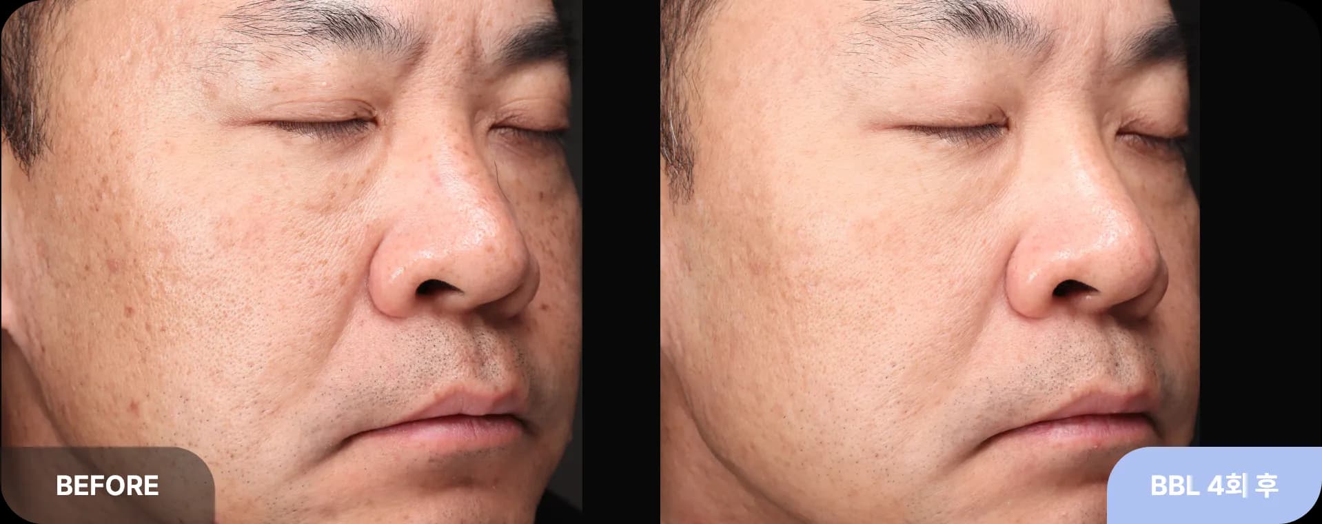 기미잡티레이저