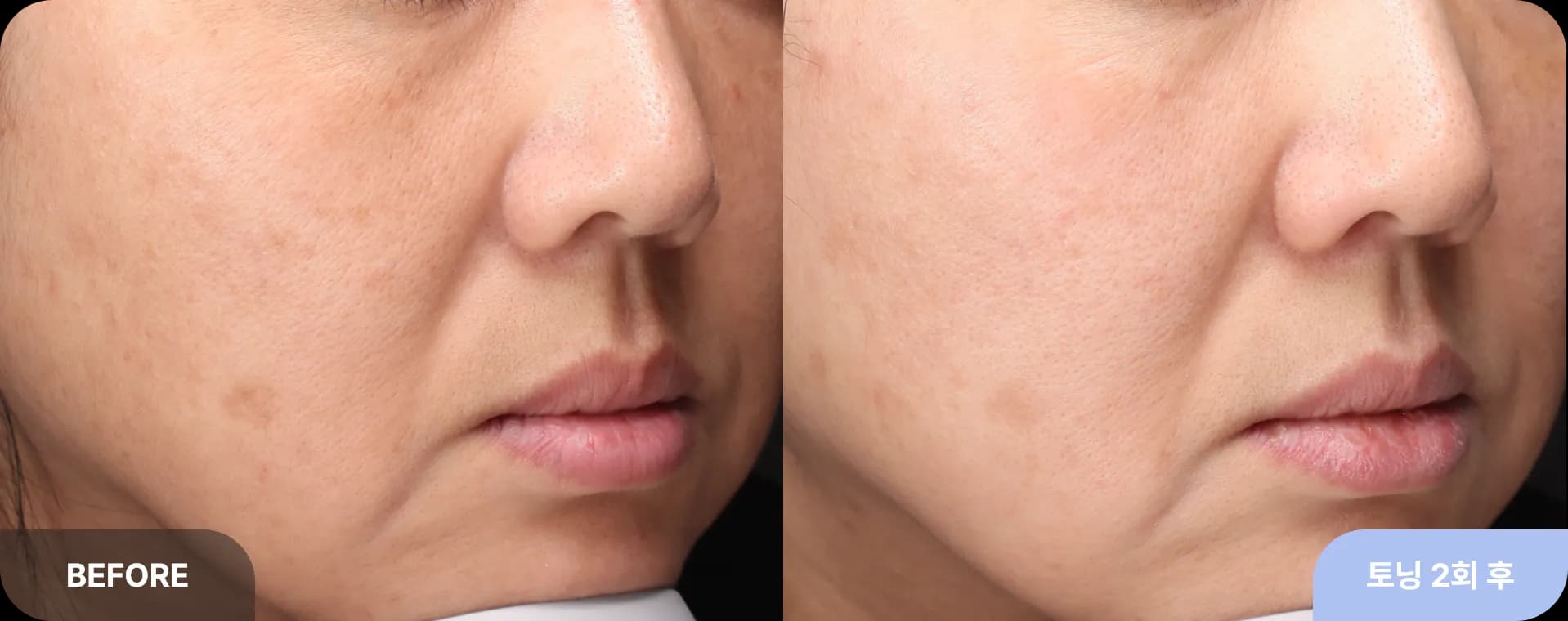 기미-토닝-레이저