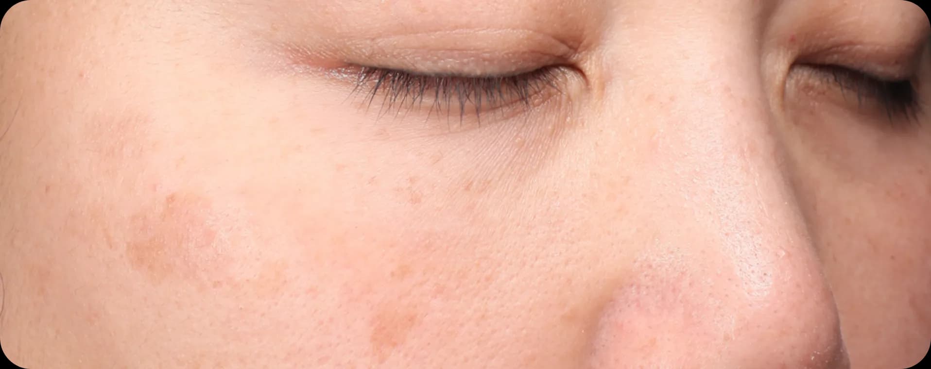 기미-주근깨-레이저