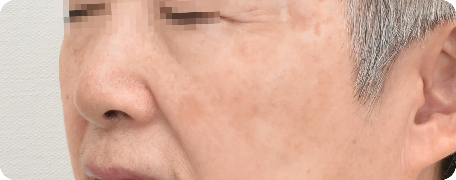 흑자레이저