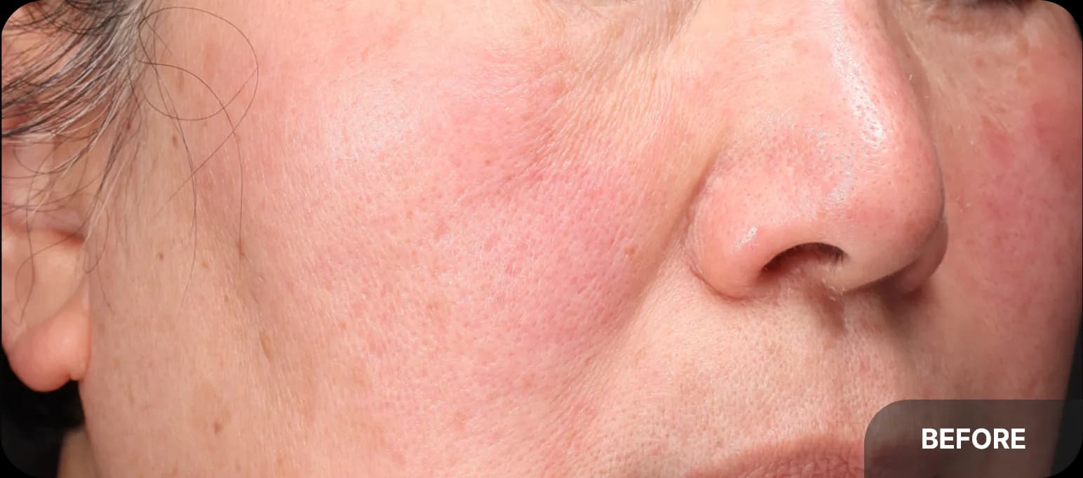 before rosacea treatment