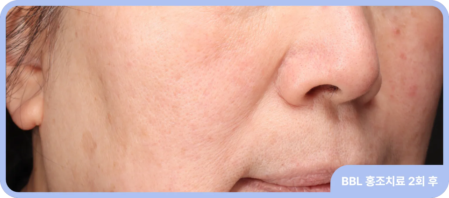 홍조나 얼굴의 혈관을 BBL로 치료한 사례
