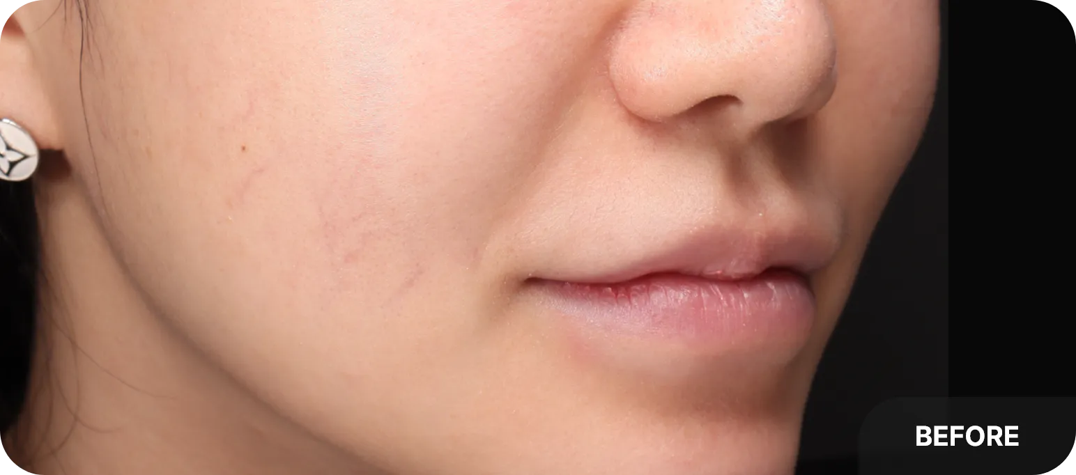 After BBL treatment for facial redness - smoother, more balanced skin tone