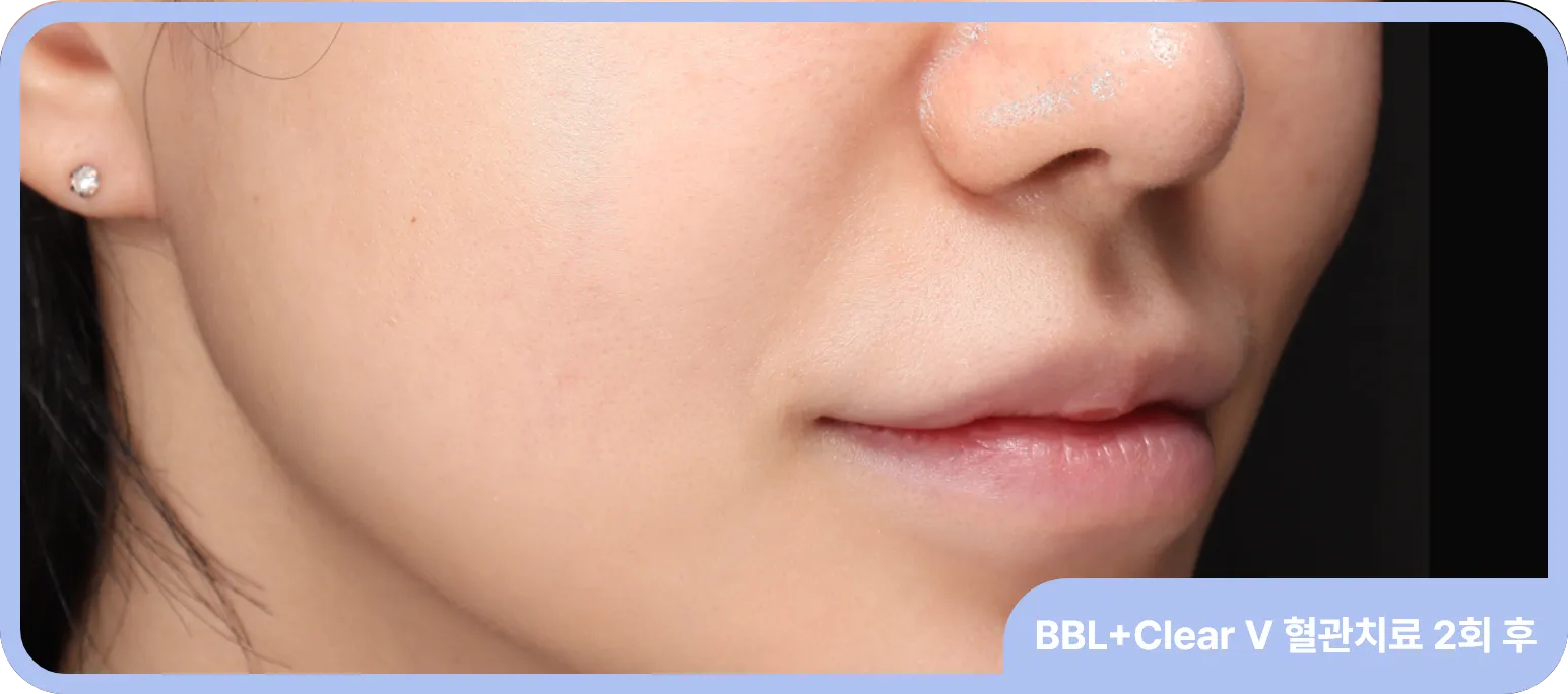 홍조나 얼굴의 혈관을 BBL로 치료한 사례