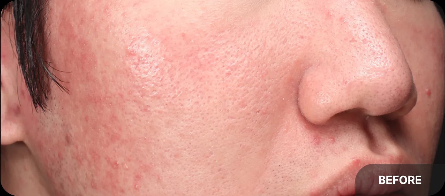 Before and after acne laser treatment