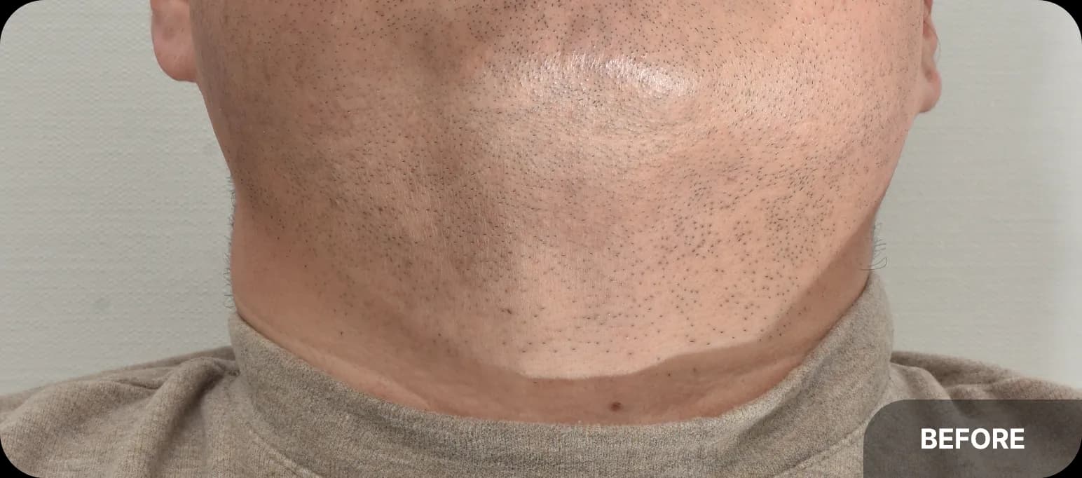 Before and after acne laser treatment