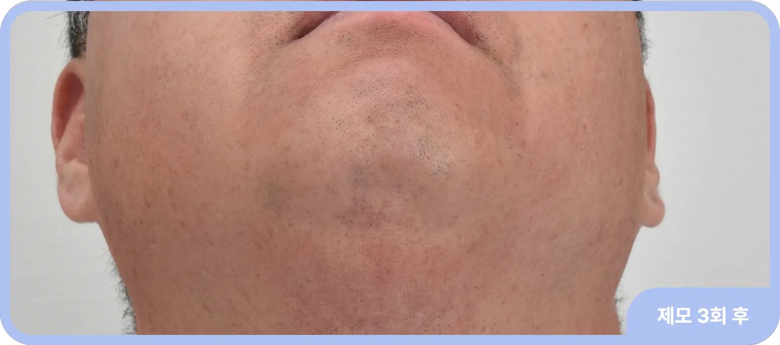 BBL을 이용한 여드름과 남성제모 레이저 전후 사례