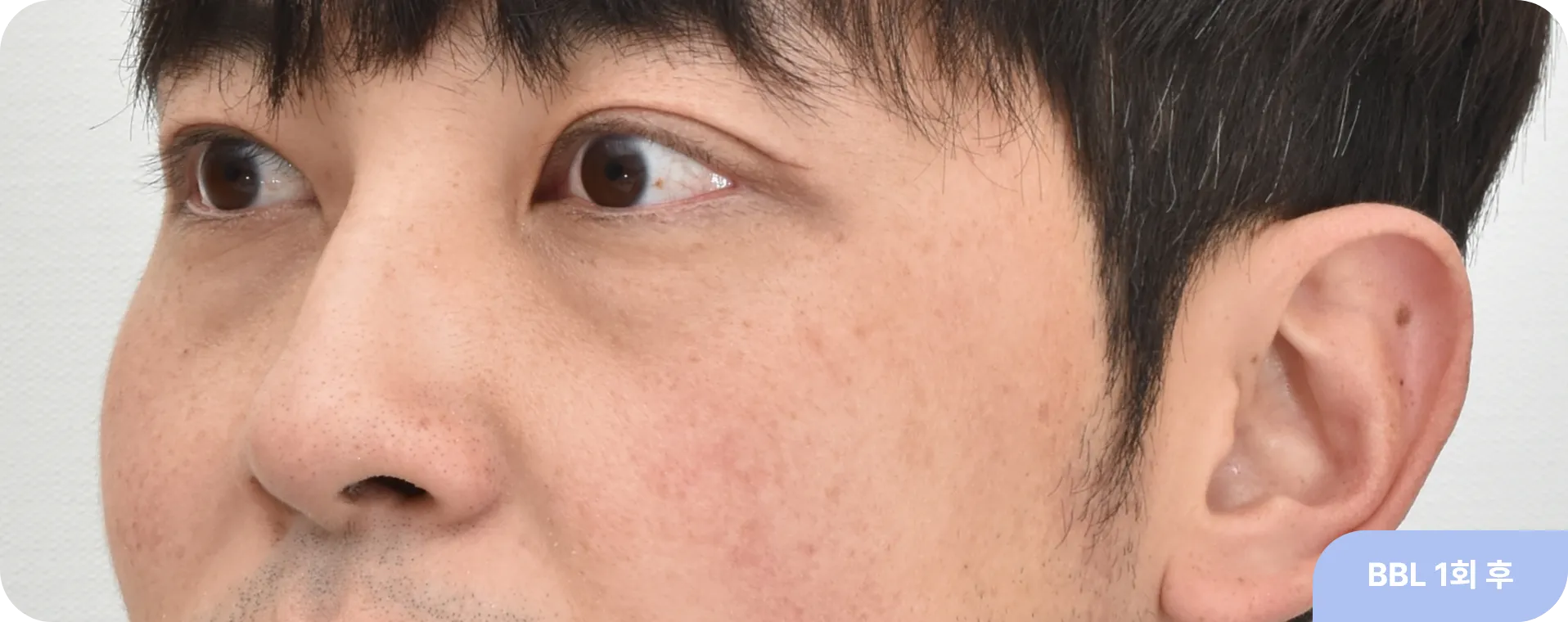 BBL-레이저-효과