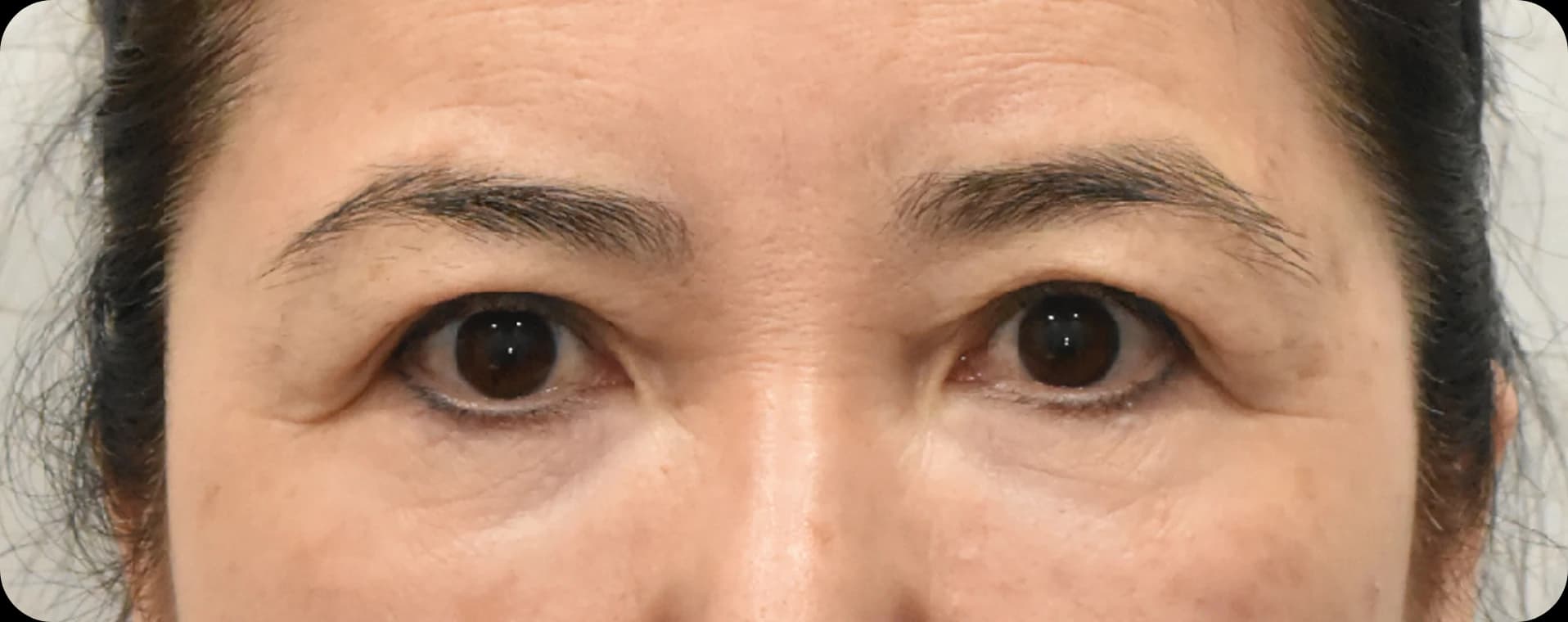 Before endoscopic forehead lift - sagging brows, crow feets, and glabellar winkles