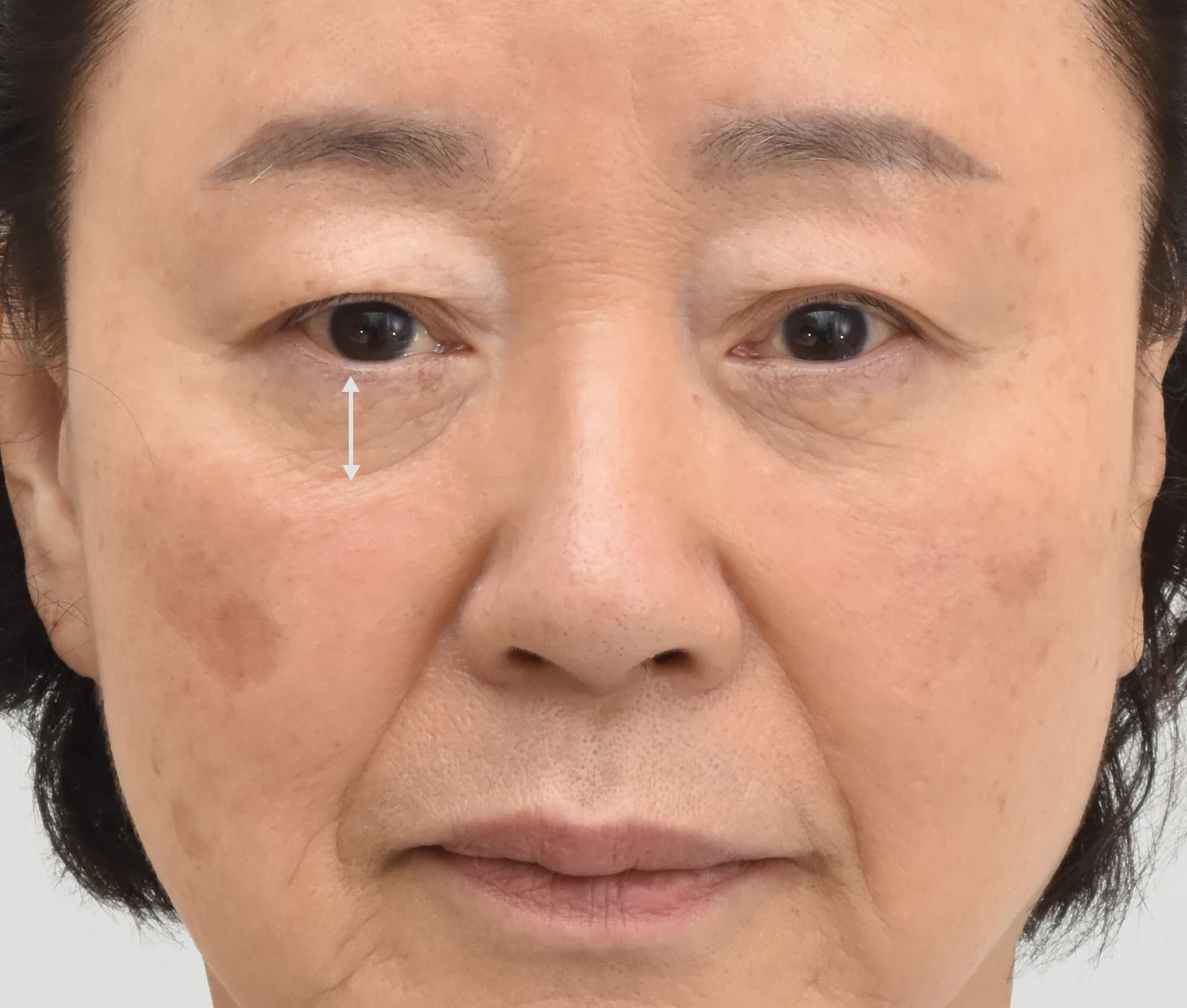 noticable nasolabial fold before facelift