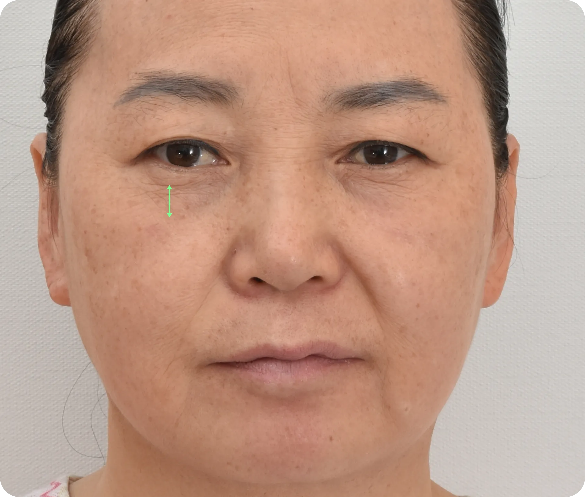 noticable nasolabial fold before facelift