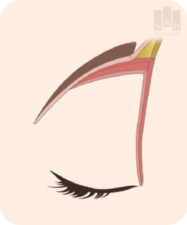 muscle lifting for long lasting subbrow lift