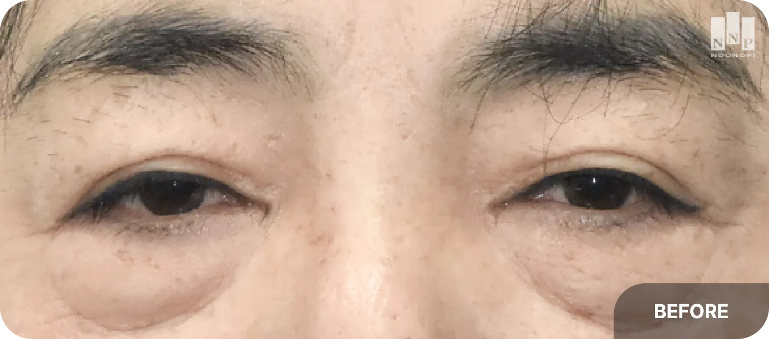 Before infra brow lift - sagging eyelid appearance and excess skin above eyes