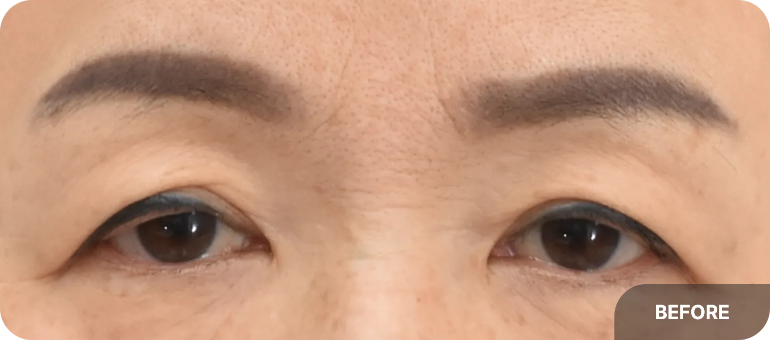 Before brow lift - droopy eyelid with skin sagging