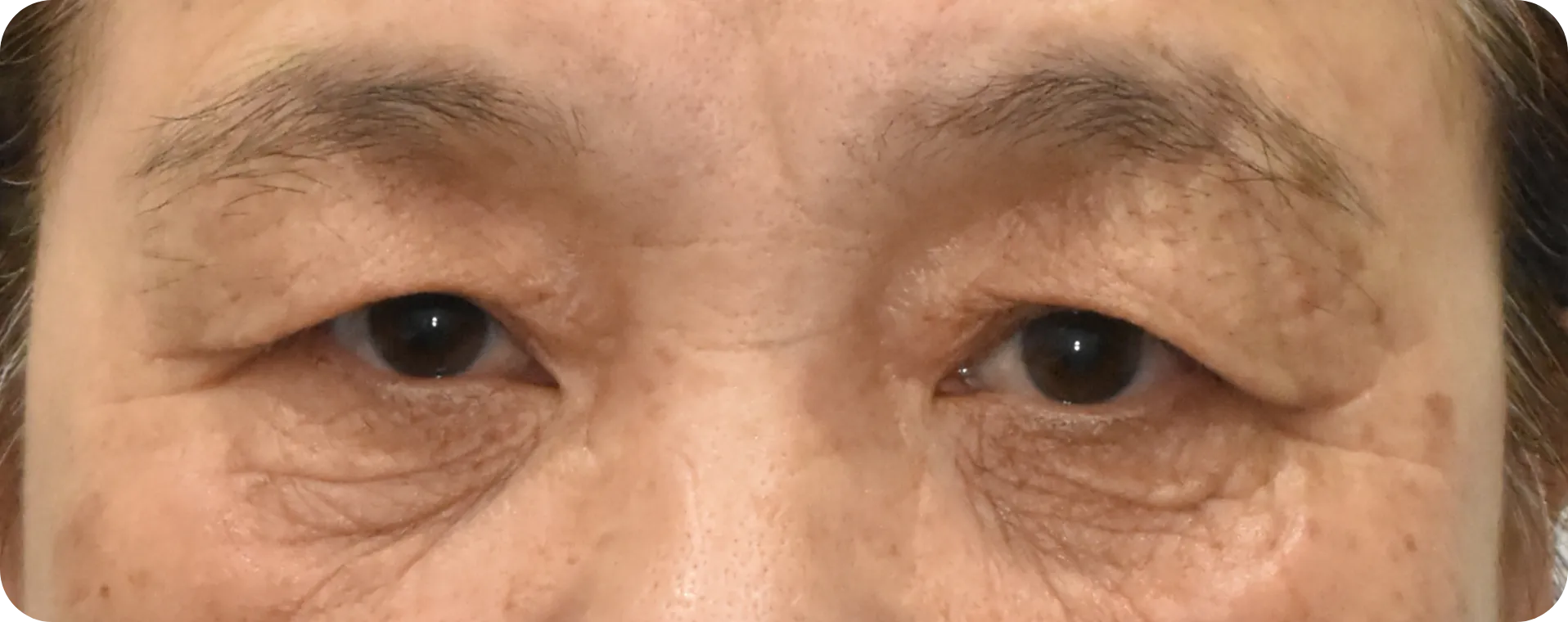 Before brow lift surgery - sagging upper lid skin and unnatural brow position