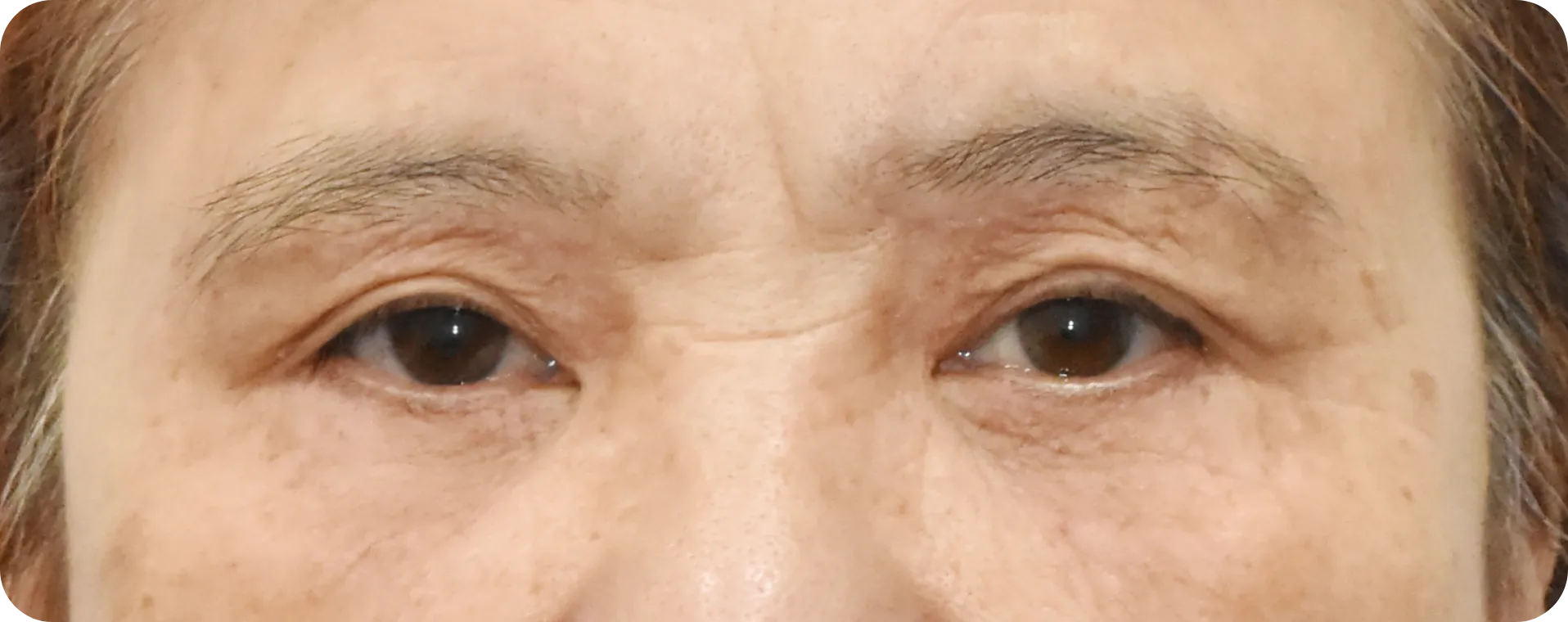 After under brow lift - improved eyebrow shape and eyelid definition