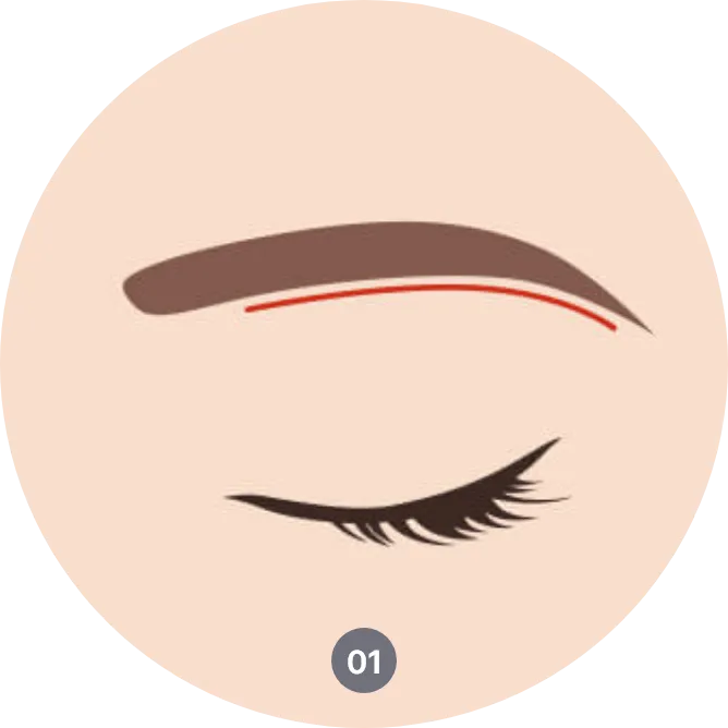 sub brow lift procedure