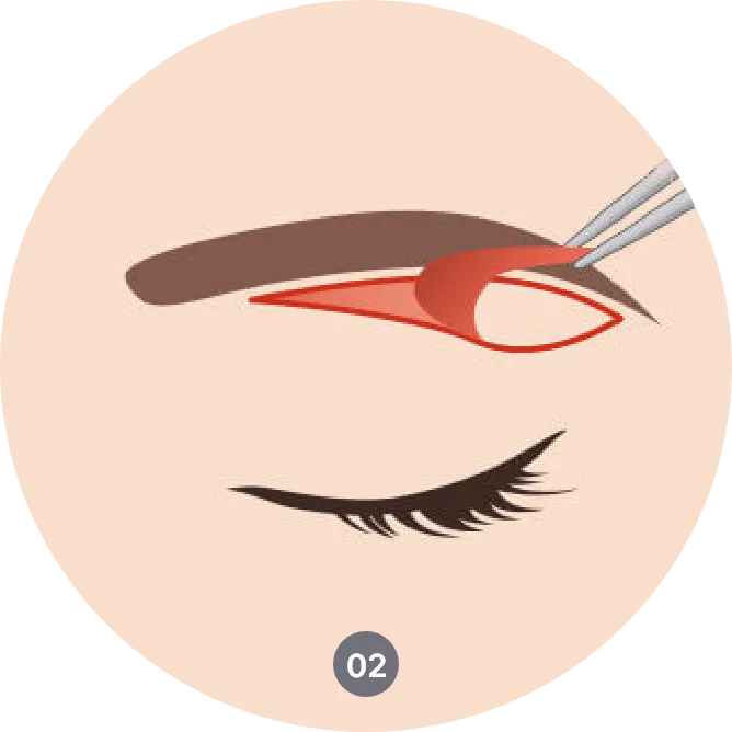 sub brow lift procedure