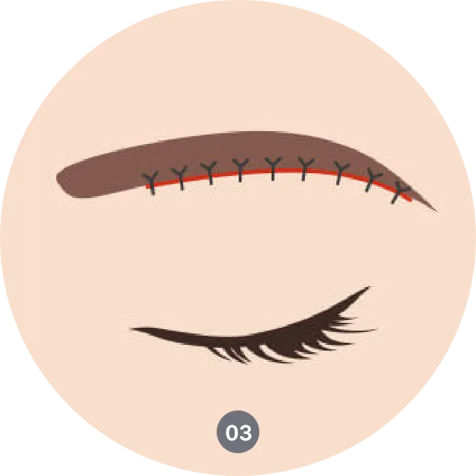 sub brow lift procedure