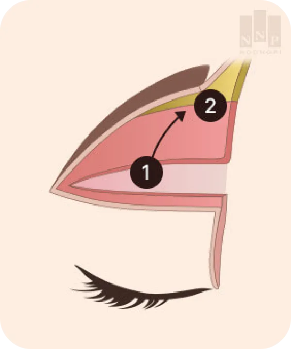 muscle lifting for long lasting subbrow lift