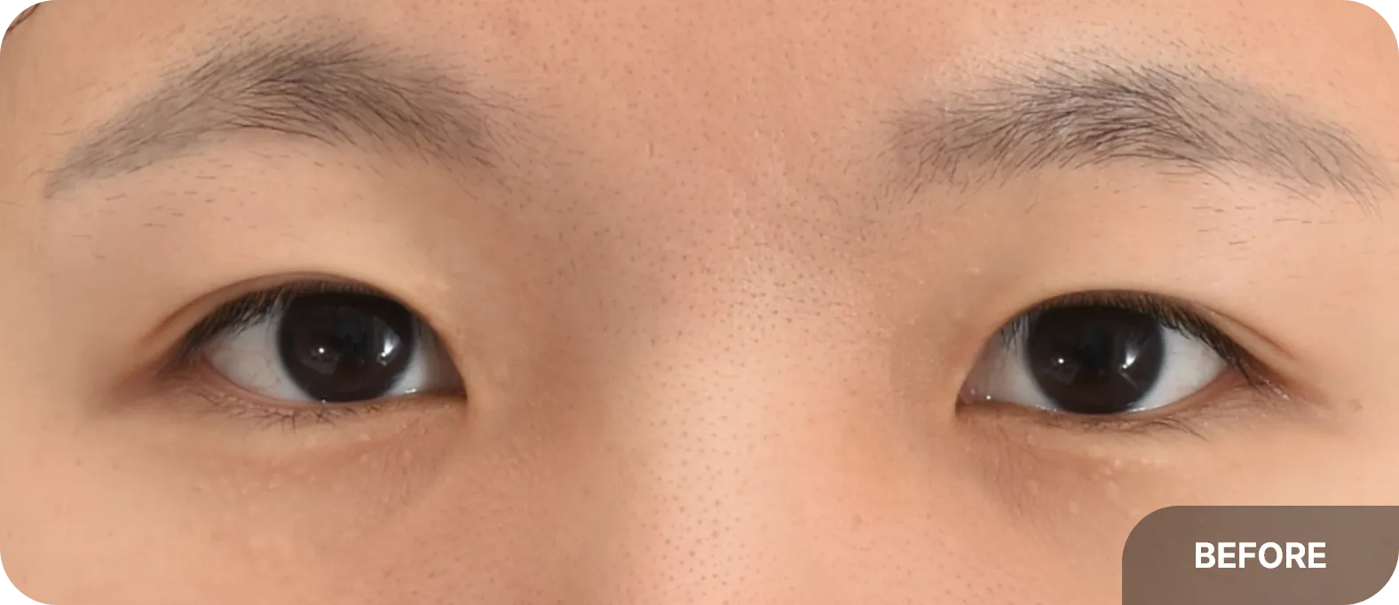 Treating less visible crease with double eyelid surgery - creating a clearer, more defined fold