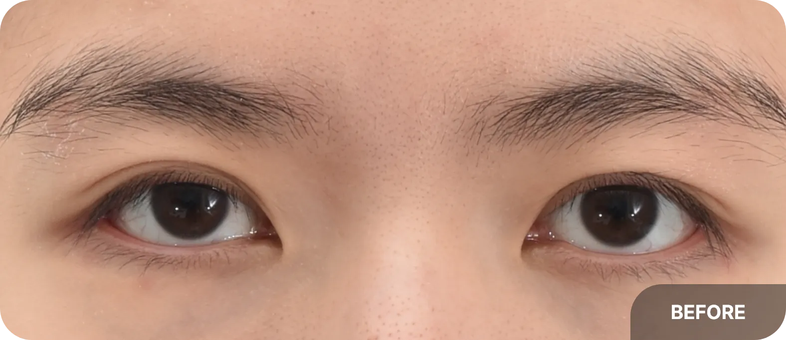 Desired treatment for less visible crease - achieving defined, natural eyelid folds after surgery