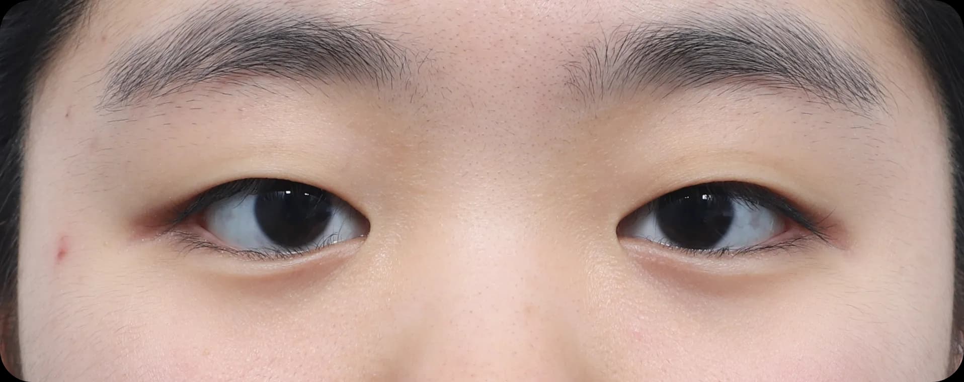 before double fold operation