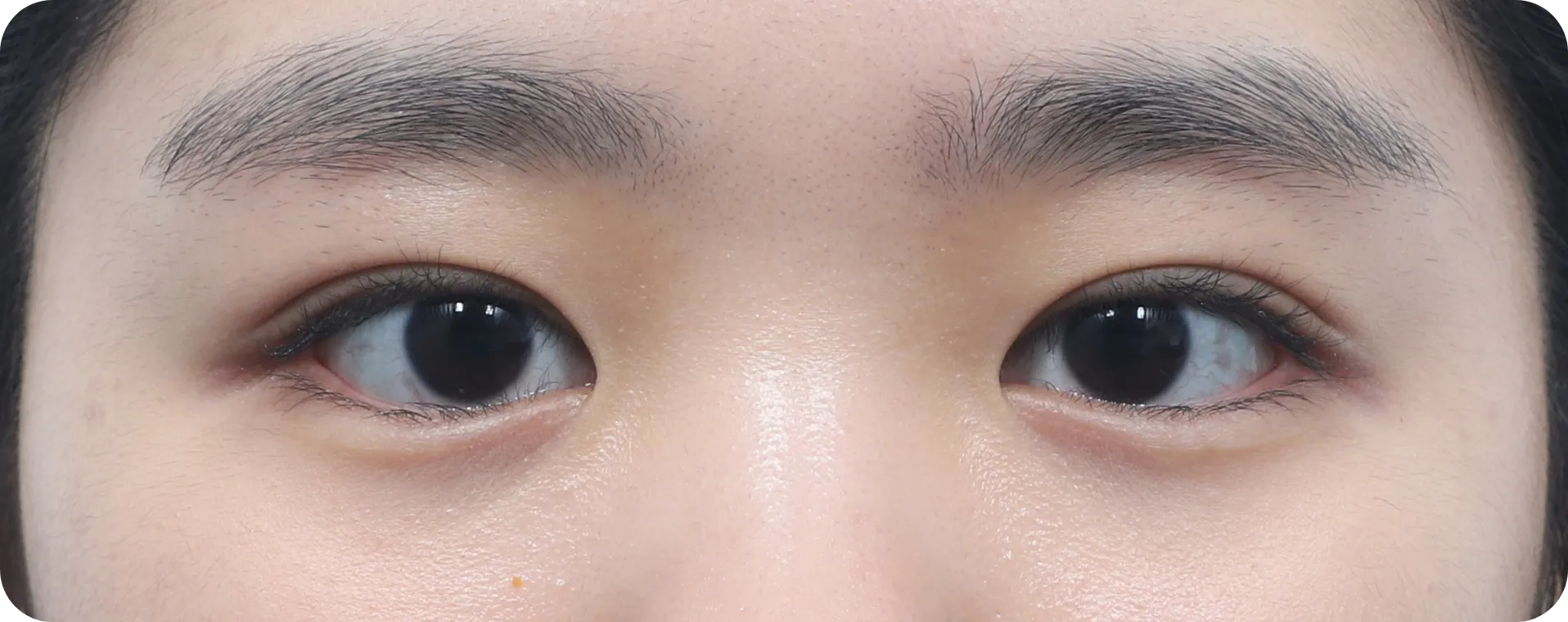 5 weeks post non-incisional double eyelid surgery - youthful, defined eyes with fast recovery