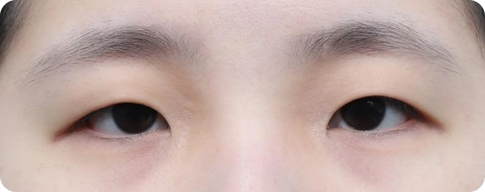 뚜렷한 라인과 오래 지속되는 효과 - 절개법 쌍꺼풀 수술 전