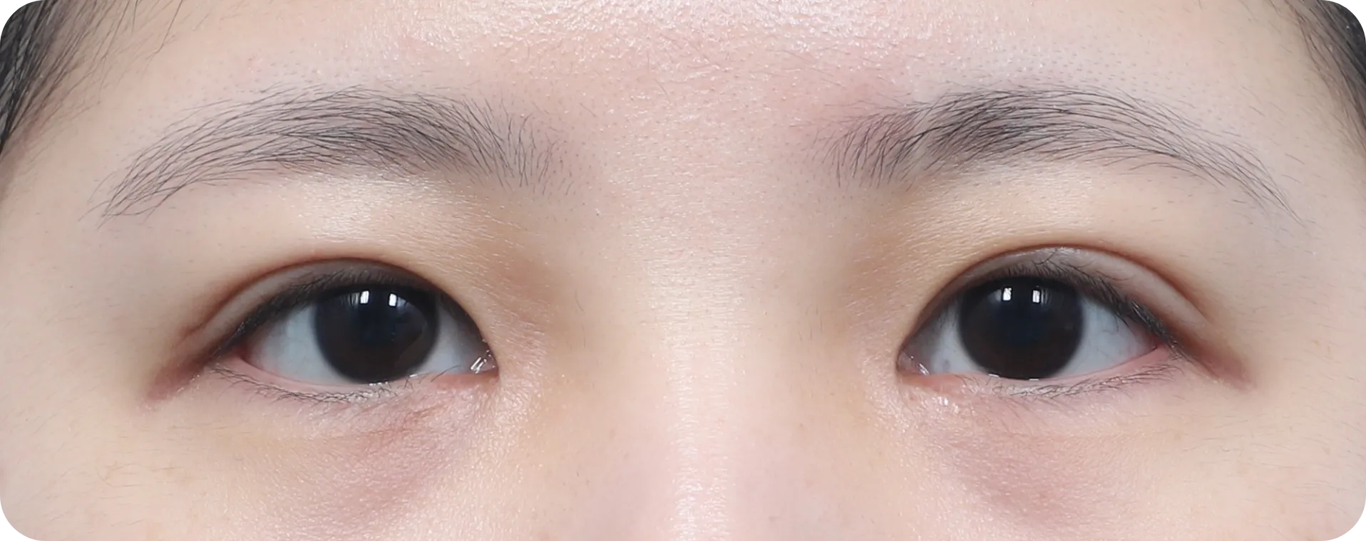 뚜렷한 라인과 오래 지속되는 효과 - 절개법 쌍꺼풀 수술 후