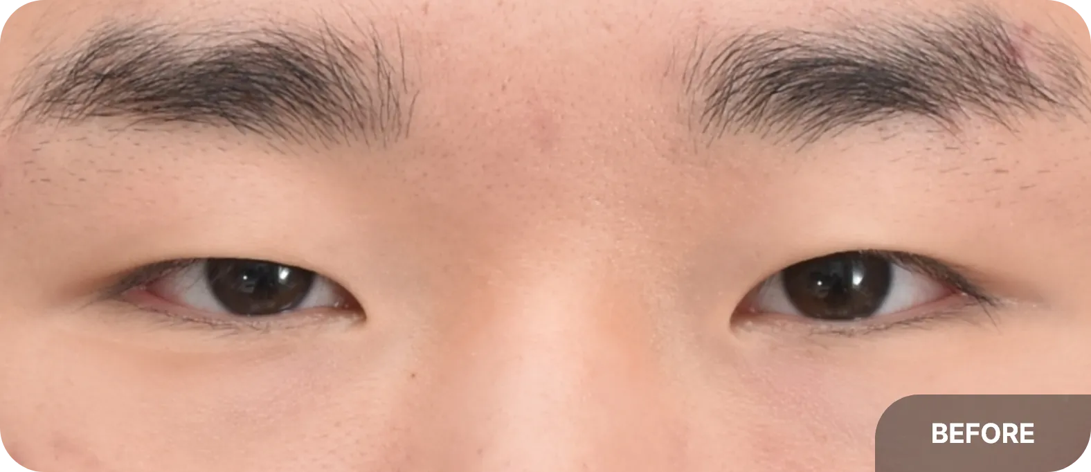 Before male double eyelid surgery - noticeable hooded upper lids and excess skin