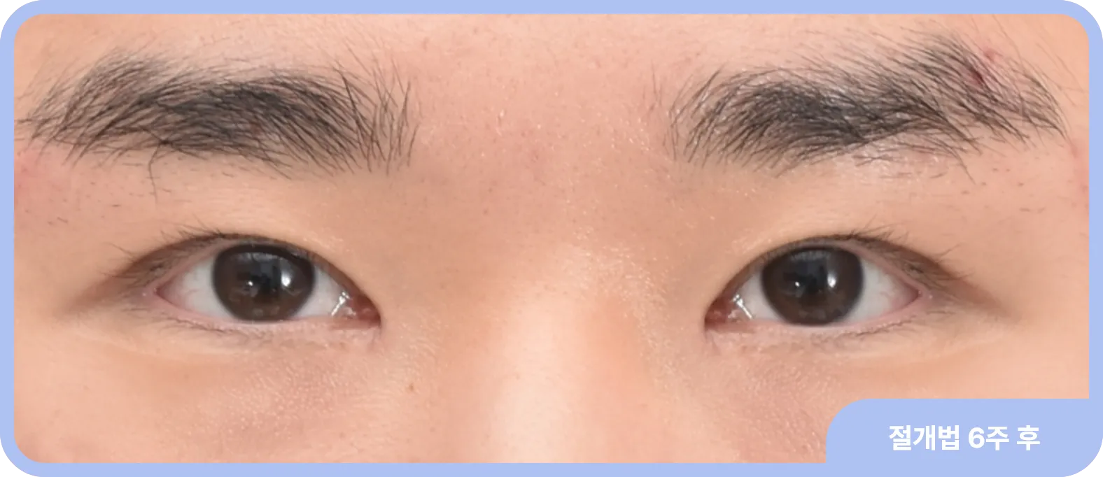 남자눈매교정 후 한층 커지고 자연스러운 모습